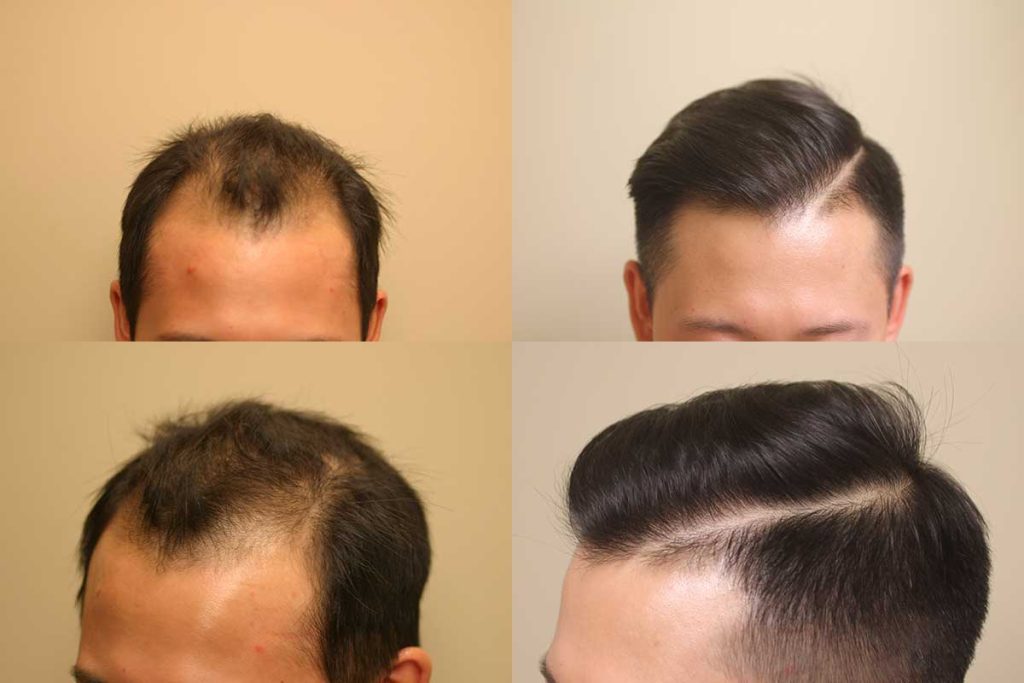 Can Hair Transplant Cure Genetic Baldness?